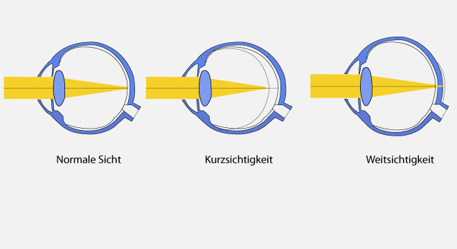 Spannende Kurzsichtig Und Weitsichtig Bilder